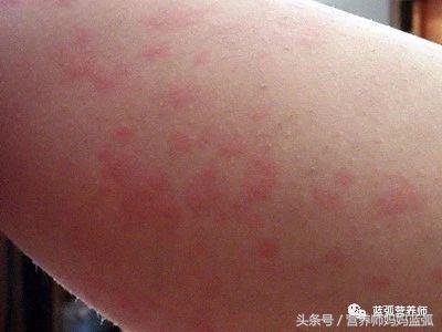 荨麻疹补钙（钙片荨麻疹）-硒宝网