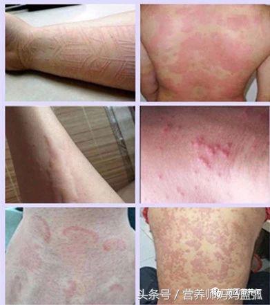 荨麻疹补钙（钙片荨麻疹）-硒宝网
