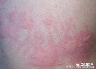 荨麻疹补钙（钙片荨麻疹）-硒宝网