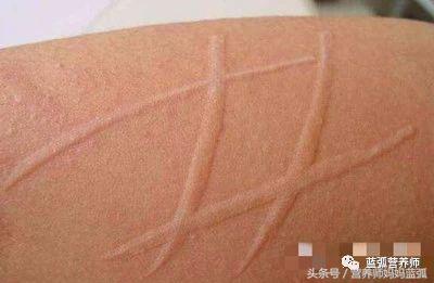 荨麻疹补钙（钙片荨麻疹）-硒宝网