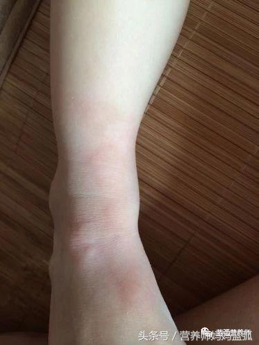 荨麻疹补钙（钙片荨麻疹）-硒宝网