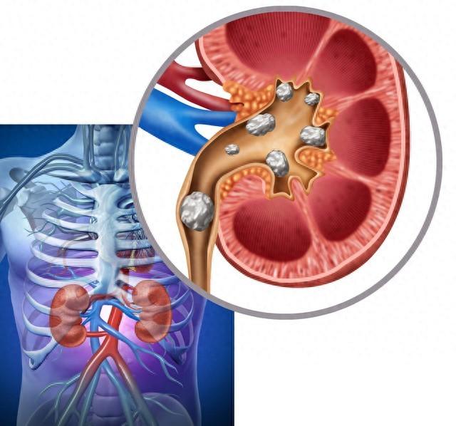 肾结石能吃钙片补钙吗（有肾结石可以吃钙片补钙吗）-硒宝网