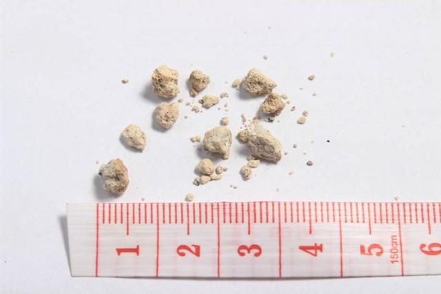 肾结石能吃钙片补钙吗（有肾结石可以吃钙片补钙吗）-硒宝网