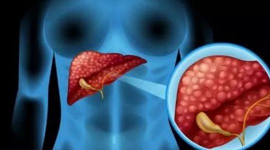 酒精性肝硬化喝富硒茶(酒精肝硬化喝茶性富硒水好吗)-硒宝网