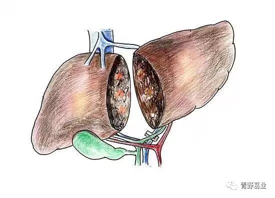 酒精性肝硬化喝富硒茶（酒精肝硬化喝茶性富硒可以吗）-硒宝网