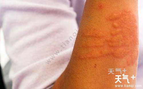 荨麻疹补钙（补钙荨麻疹会好吗）-硒宝网