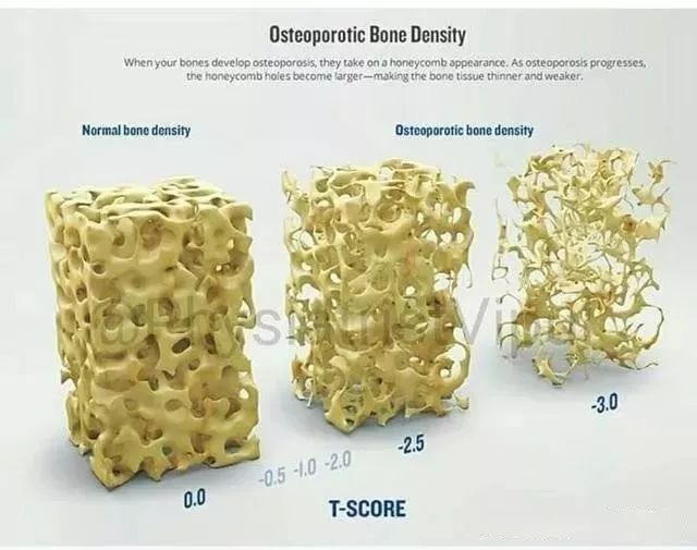 骨折补钙吃什么钙片好(骨折吃钙片)-硒宝网