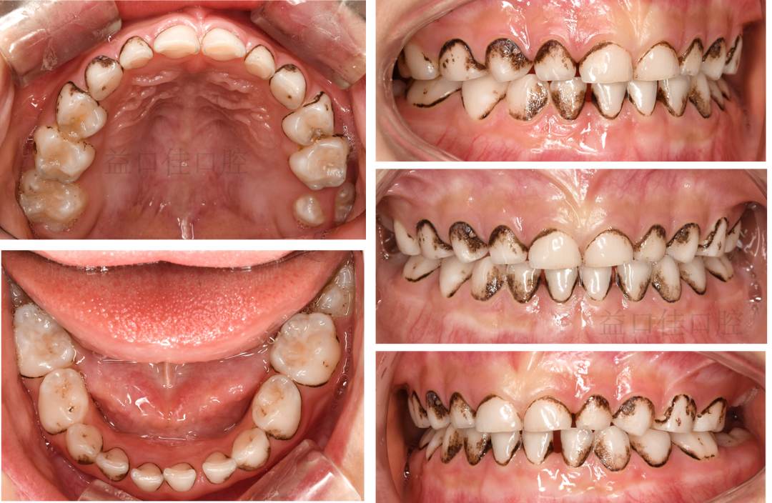 补铁牙齿变黑了怎么办（补铁黑牙怎么办）-硒宝网