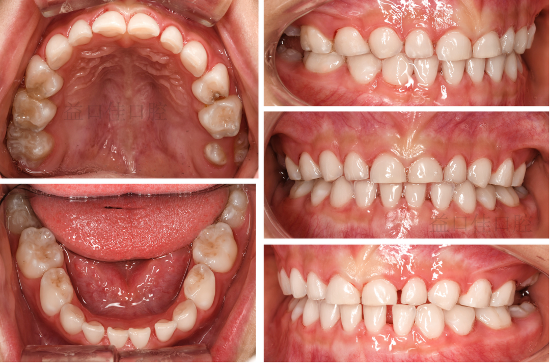 补铁牙齿变黑了怎么办（补铁黑牙怎么办）-硒宝网