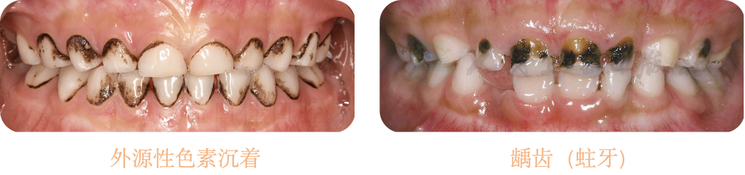 补铁牙齿变黑了怎么办（补铁黑牙怎么办）-硒宝网