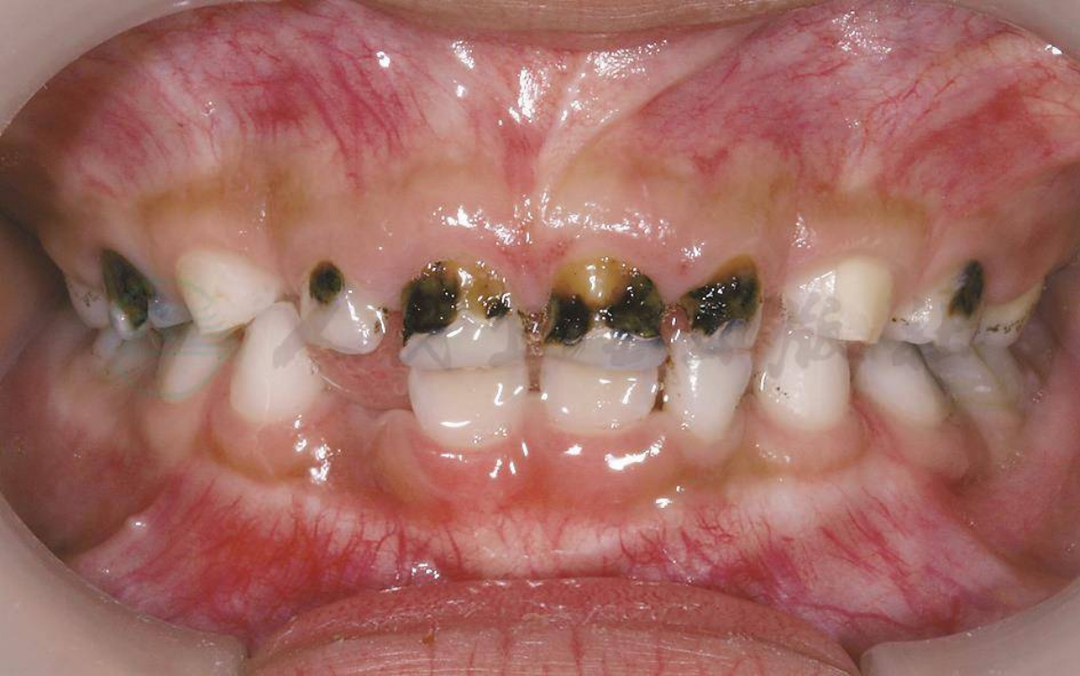 补铁牙齿变黑了怎么办（补铁黑牙怎么办）-硒宝网