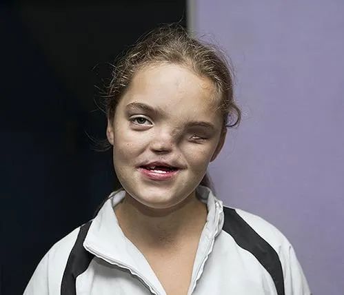 桥本甲状腺吃含硒产品(桥本甲状腺炎吃硒)-硒宝网