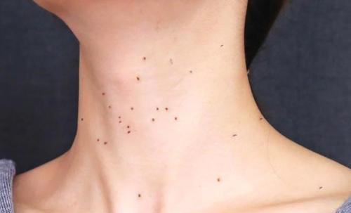 硒维康副作用胸前长痘(硒痘痘)-硒宝网