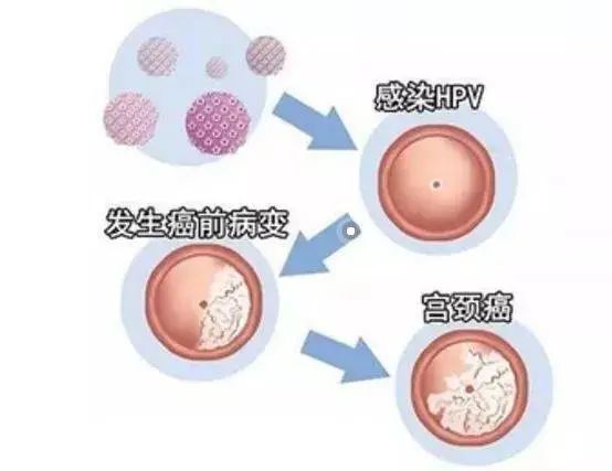 硒维康对HPV有用吗（硒维康口嚼片对hpv）-硒宝网