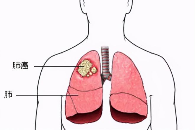 硒维康对肺肿瘤有作用（肺癌吃硒维康口嚼片有用吗）-硒宝网