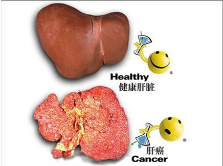 硒维康对肝癌有没有用(硒维康肝癌可以吃吗)-硒宝网