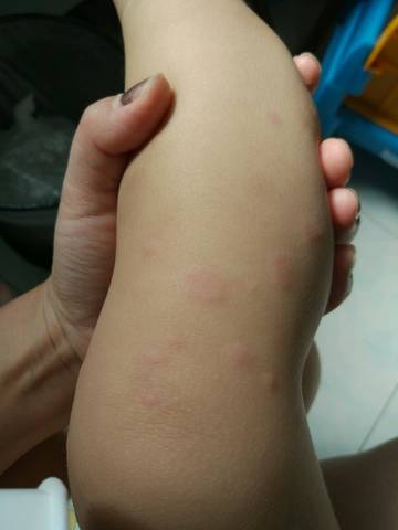 宝宝吃了锌硒宝长湿疹(锌湿疹宝宝宝吃长硒片有用吗)-硒宝网