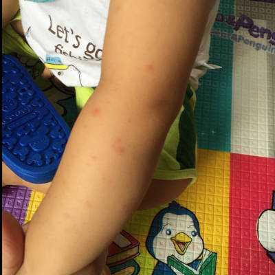 宝宝吃了锌硒宝长湿疹(锌湿疹宝宝宝吃长硒片有用吗)-硒宝网