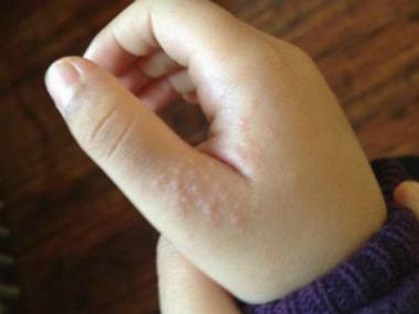 hpv患者吃锌硒宝片（锌硒宝片能抵抗hpv吗）-硒宝网