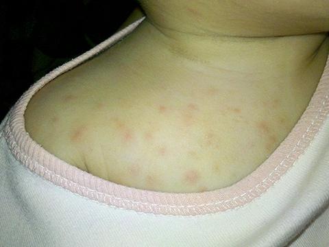 hpv患者吃锌硒宝片（锌硒宝片能抵抗hpv吗）-硒宝网