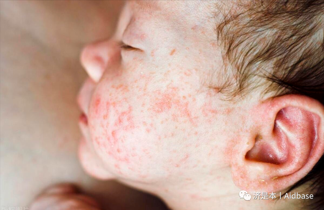 荨麻疹能吃锌硒宝片吗（荨麻疹吃锌有用吗）-硒宝网