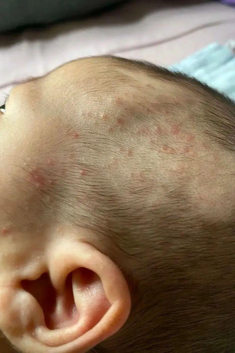 荨麻疹能吃锌硒宝片吗（荨麻疹吃锌有用吗）-硒宝网