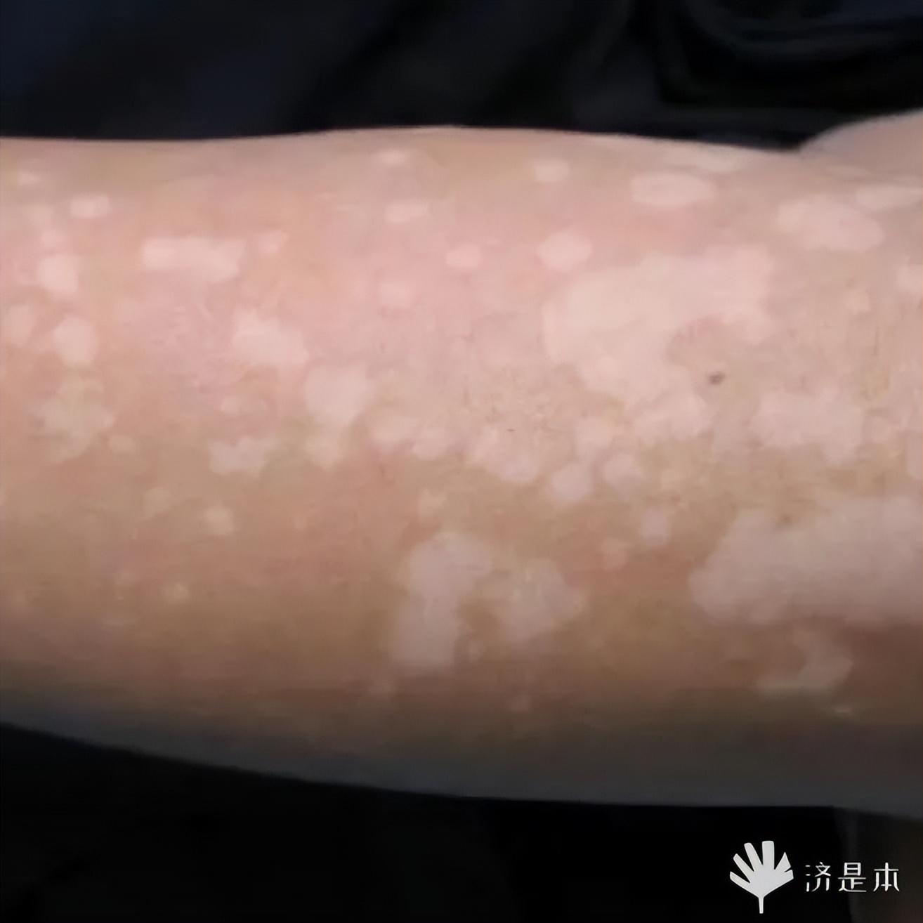 荨麻疹能吃锌硒宝片吗（荨麻疹吃锌有用吗）-硒宝网