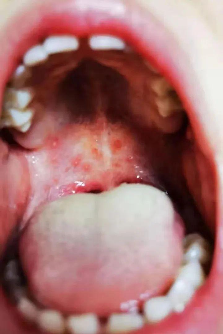 荨麻疹能吃锌硒宝片吗（荨麻疹吃锌有用吗）-硒宝网