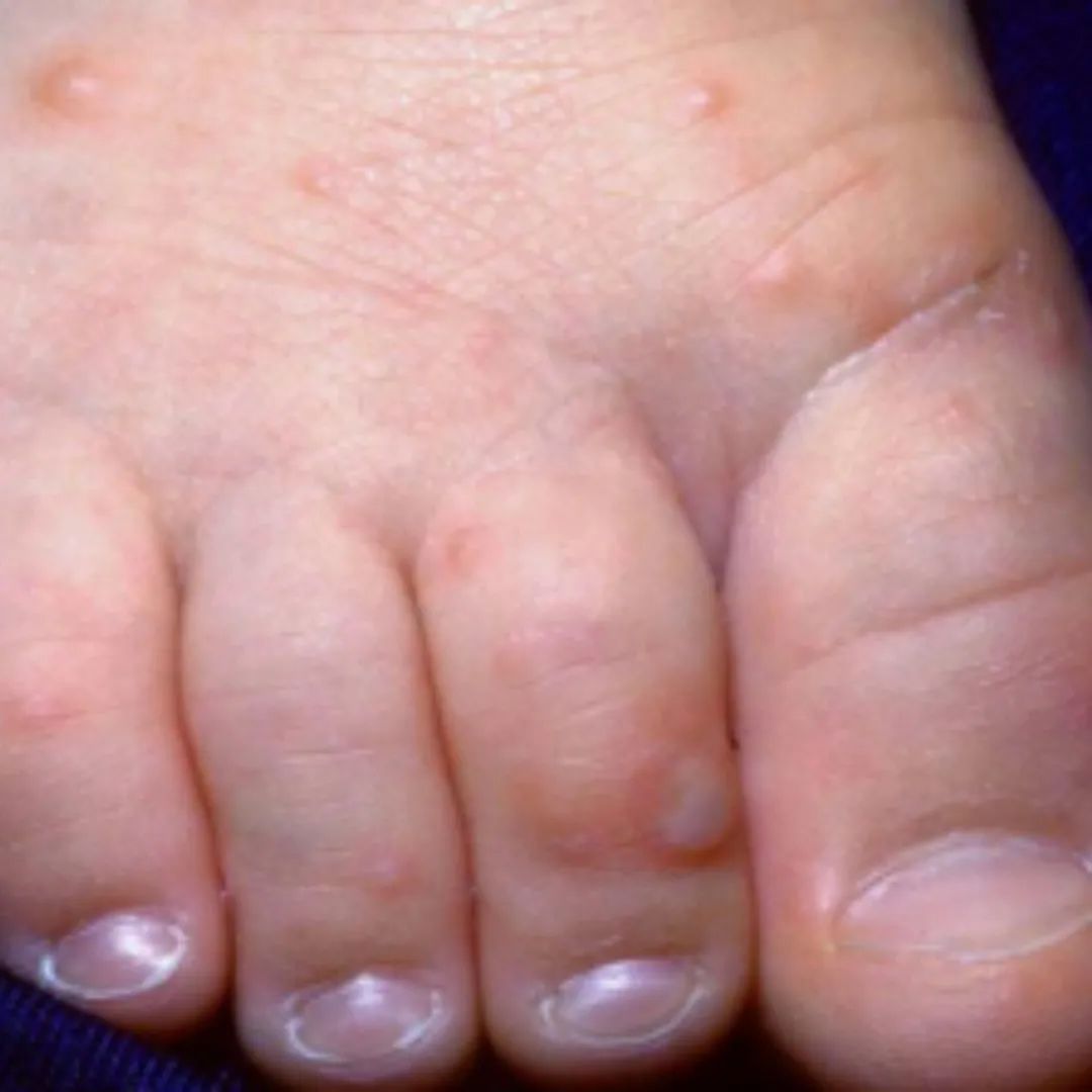 荨麻疹能吃锌硒宝片吗（荨麻疹吃锌有用吗）-硒宝网