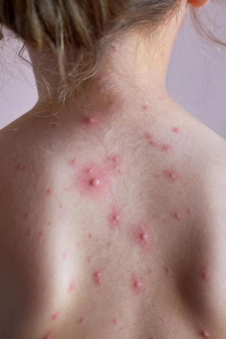 荨麻疹能吃锌硒宝片吗（荨麻疹吃锌有用吗）-硒宝网