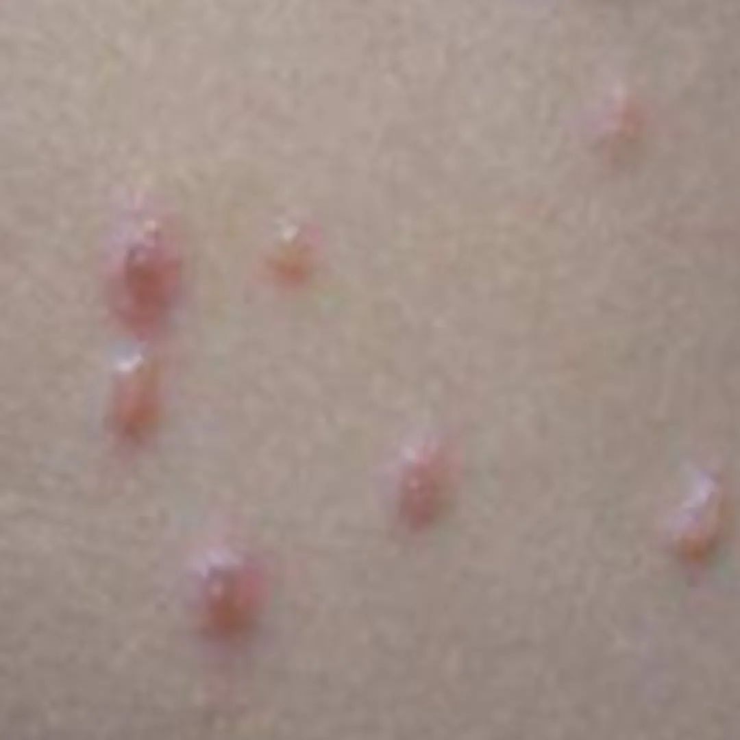 荨麻疹能吃锌硒宝片吗（荨麻疹吃锌有用吗）-硒宝网