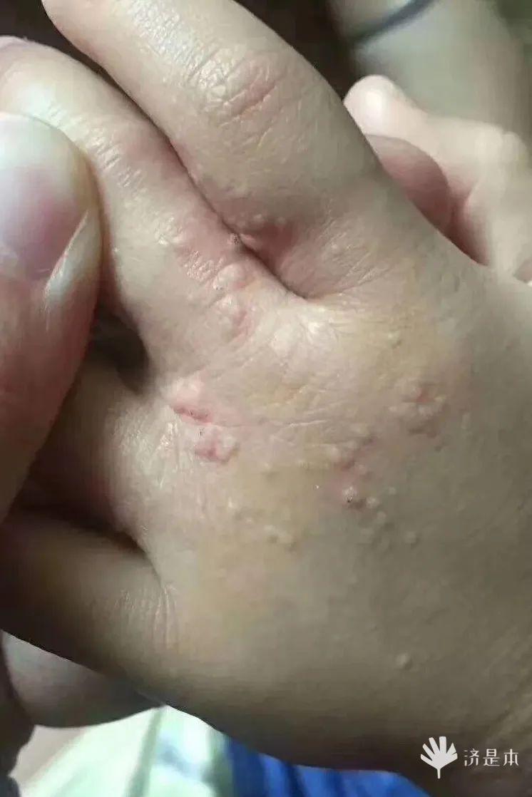 荨麻疹能吃锌硒宝片吗（荨麻疹吃锌有用吗）-硒宝网