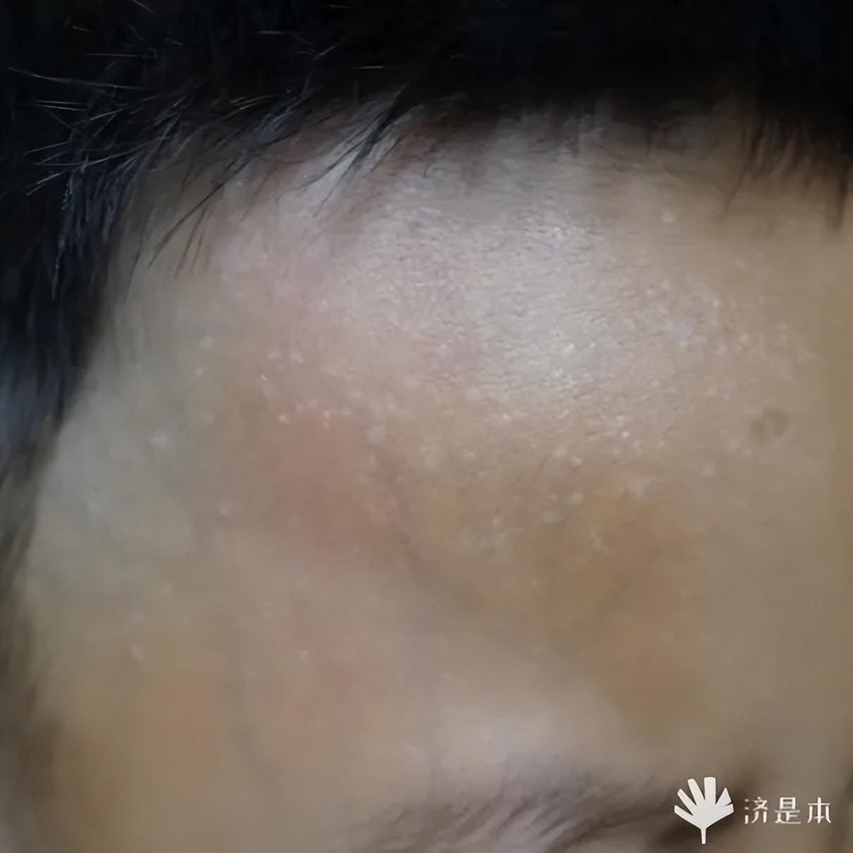 荨麻疹能吃锌硒宝片吗（荨麻疹吃锌有用吗）-硒宝网