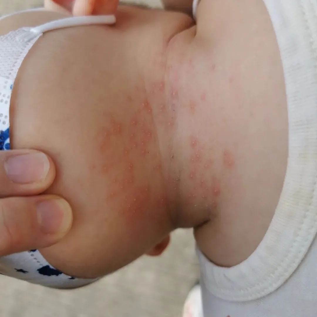 荨麻疹能吃锌硒宝片吗（荨麻疹吃锌有用吗）-硒宝网