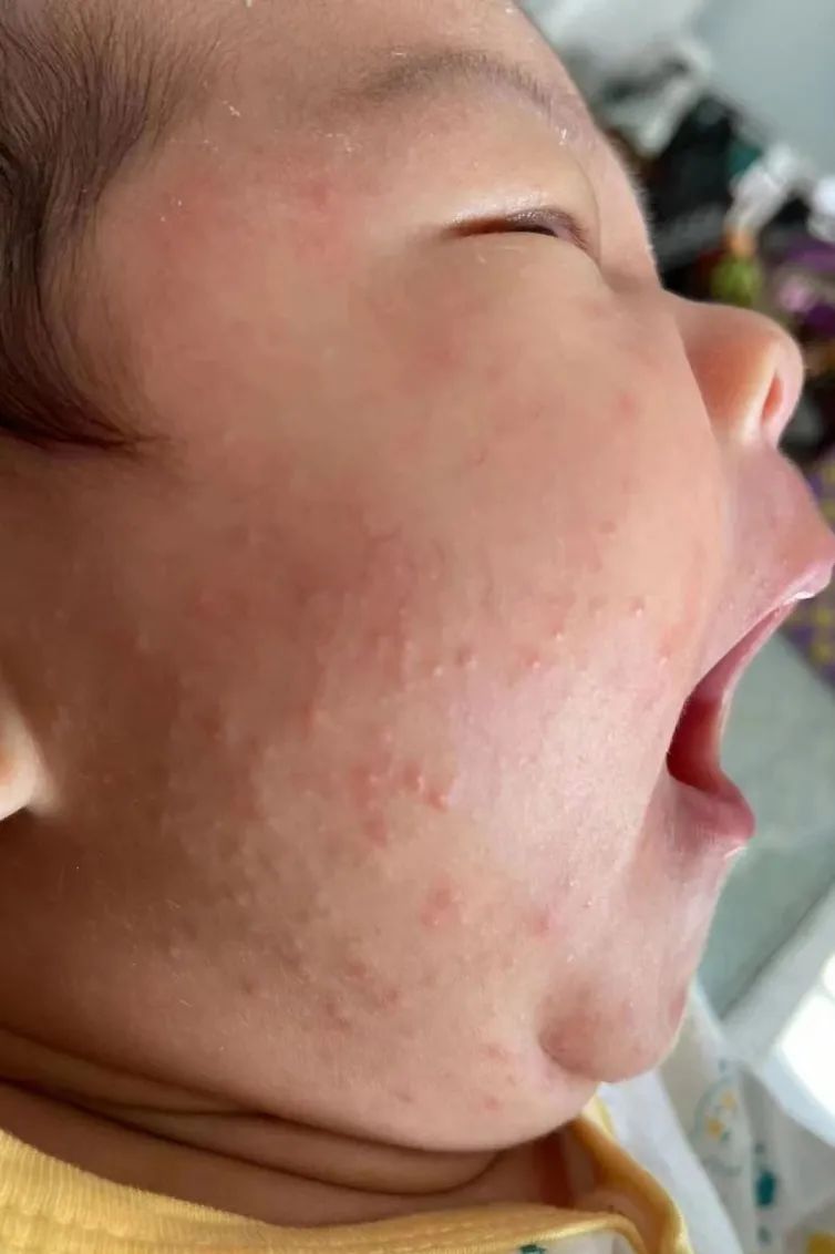 荨麻疹能吃锌硒宝片吗（荨麻疹吃锌有用吗）-硒宝网