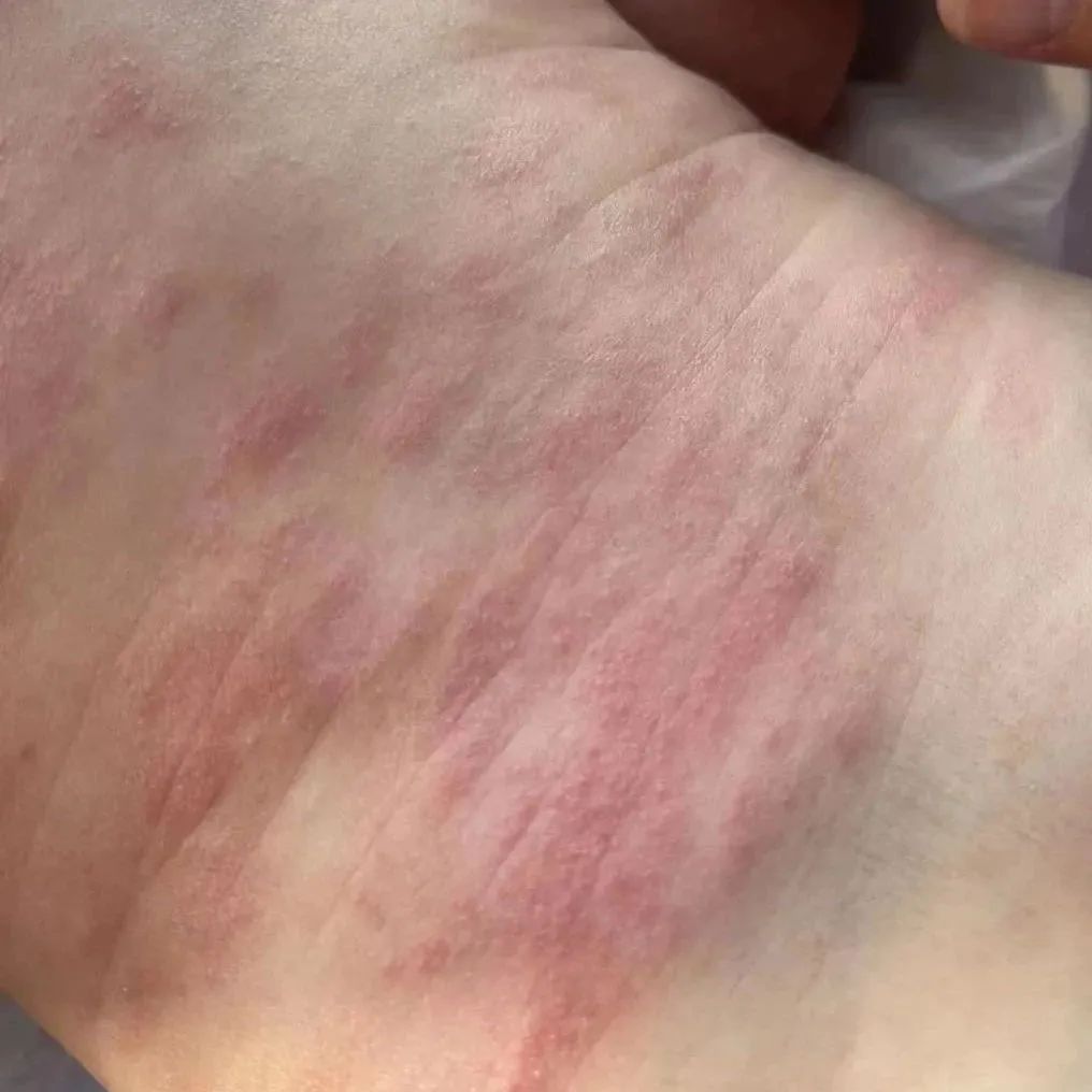 荨麻疹能吃锌硒宝片吗（荨麻疹吃锌有用吗）-硒宝网