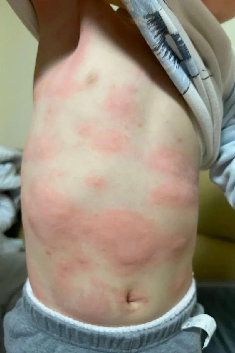 荨麻疹能吃锌硒宝片吗（荨麻疹吃锌有用吗）-硒宝网