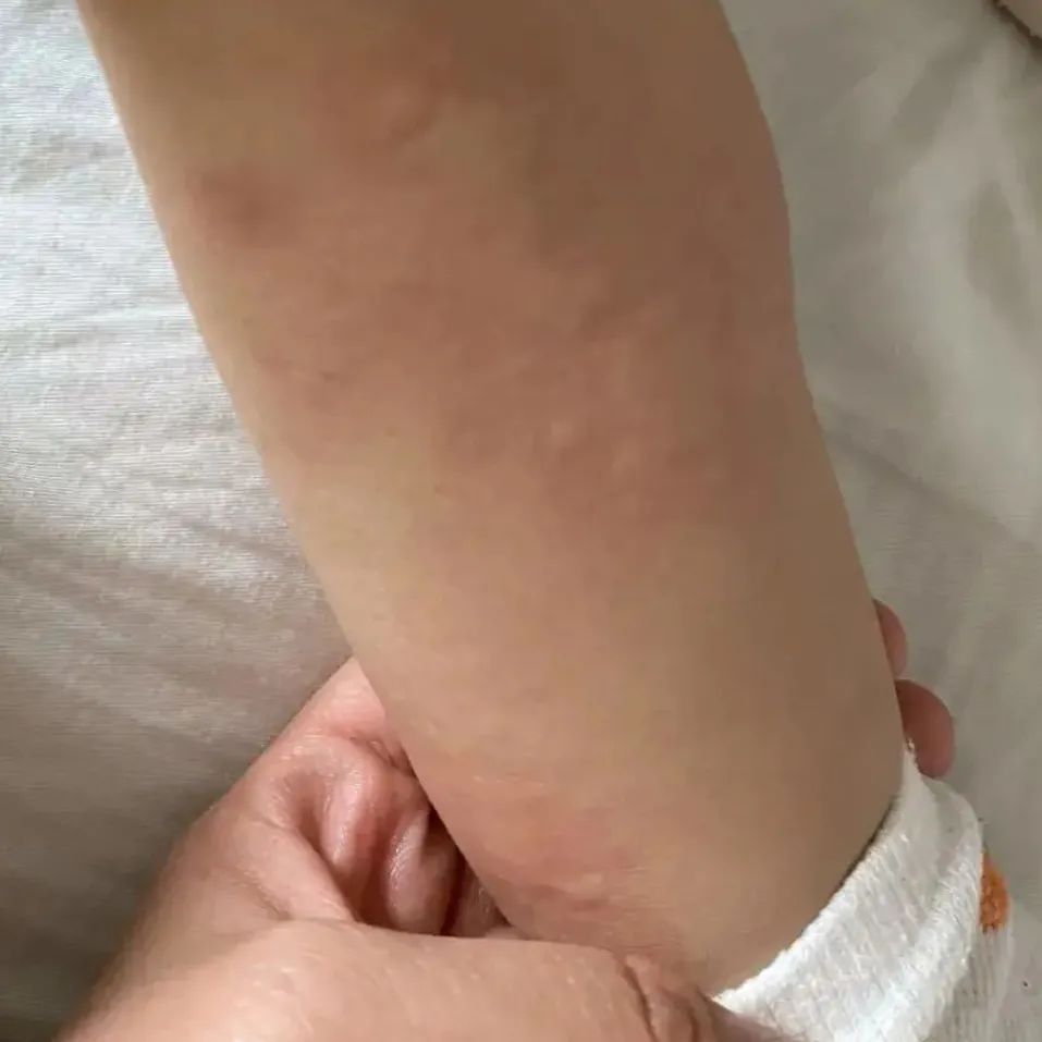 荨麻疹能吃锌硒宝片吗（荨麻疹吃锌有用吗）-硒宝网