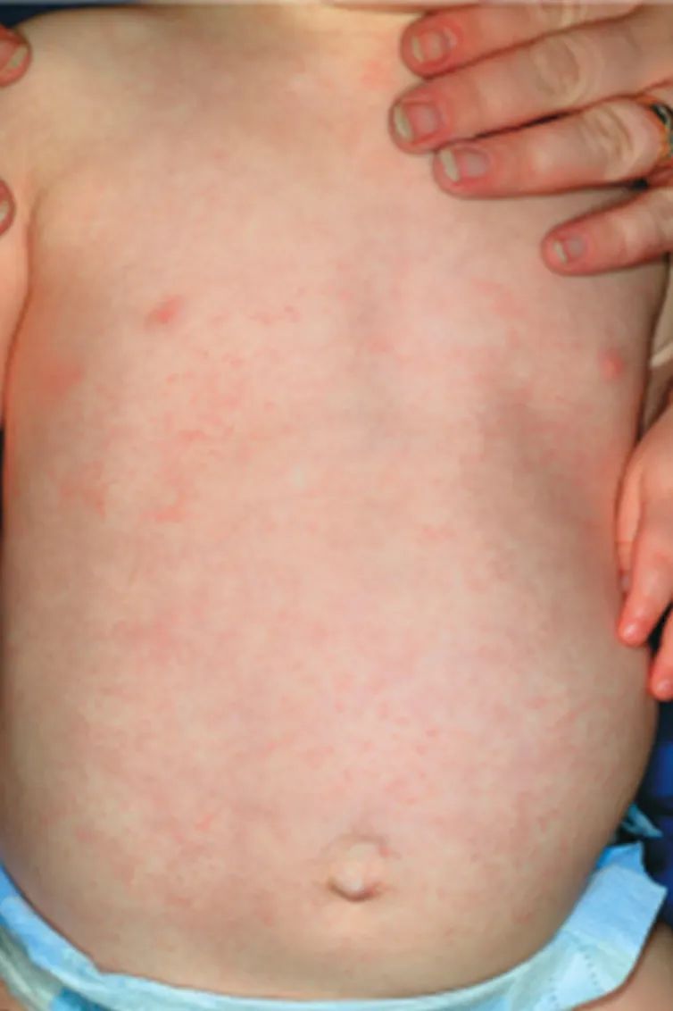 荨麻疹能吃锌硒宝片吗（荨麻疹吃锌有用吗）-硒宝网