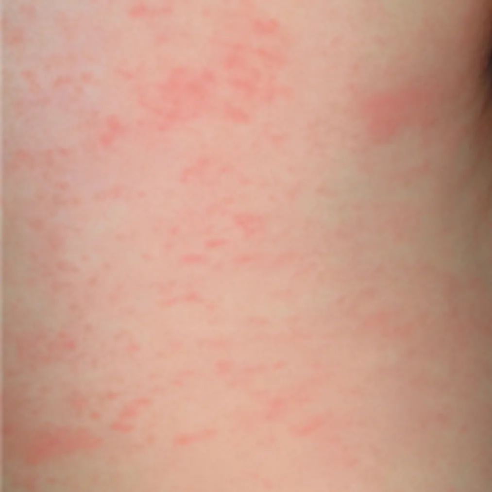 荨麻疹能吃锌硒宝片吗（荨麻疹吃锌有用吗）-硒宝网