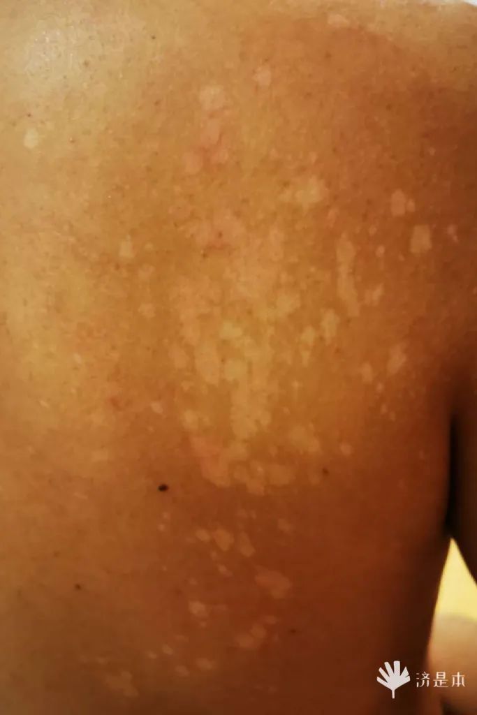 荨麻疹能吃锌硒宝片吗（荨麻疹吃锌有用吗）-硒宝网