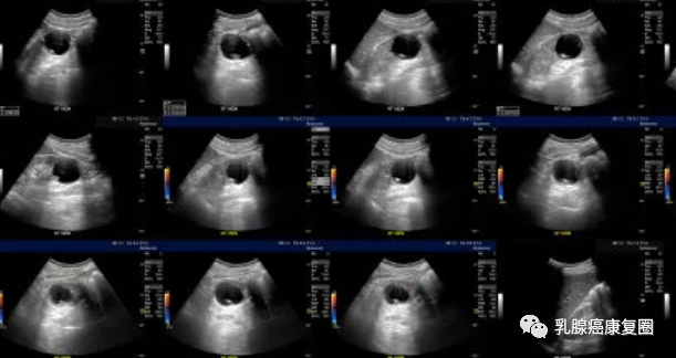 管状腺瘤切除可以补硒吗(管状腺瘤切除后需要服用药物吗)-硒宝网