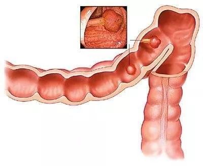 管状腺瘤切除可以补硒吗（管状腺瘤切除后多久可以喝酒）-硒宝网