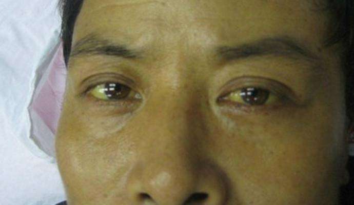 补麦芽硒会出现什么症状（吃麦芽硒会掉发吗）-硒宝网