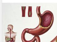 结肠腺癌中晚期补硒好吗（结肠癌可以吃硒吗）-硒宝网