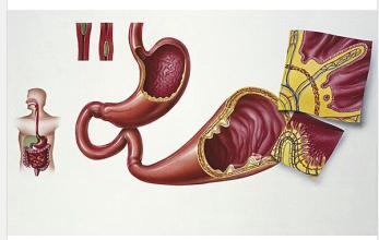 结肠腺癌中晚期补硒好吗（结肠癌可以吃硒吗）-硒宝网