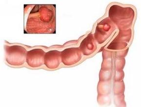 结肠腺癌中晚期补硒好吗（结肠癌可以吃硒吗）-硒宝网