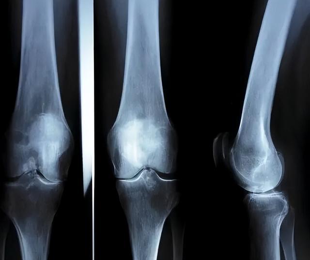 中年人补钙什么钙片效果最好（效果中年补钙钙片好人用吗）-硒宝网