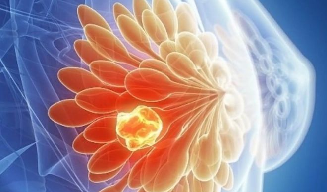 补硒导致乳腺增生加重吗（乳腺增生吃硒有效果吗）-硒宝网