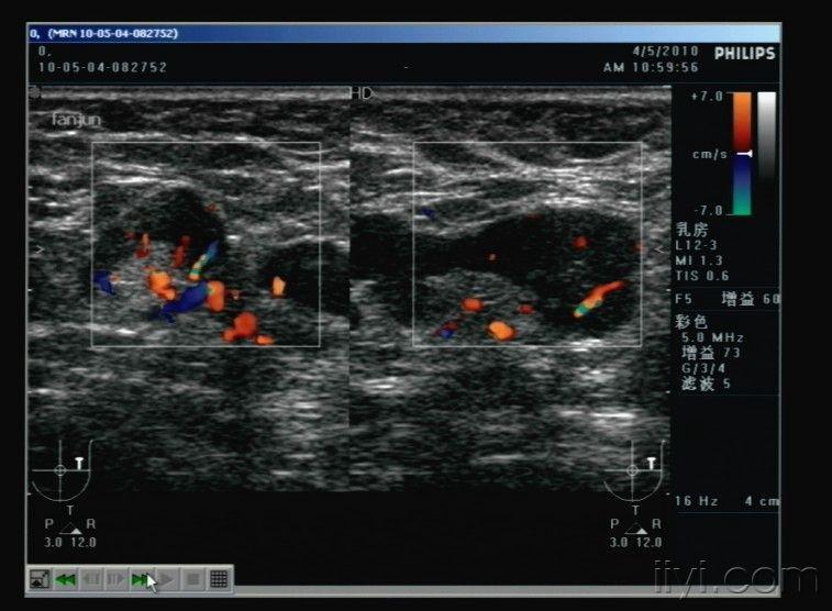 补硒能让乳腺结节消失吗（乳腺结节吃硒片有用吗）-硒宝网
